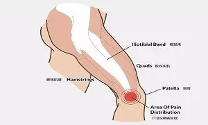 Hội chứng dải chậu chày - IT Band và cách khắc phục nó