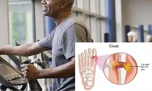 Người bị Gout có nên tập gym và tập thế nào