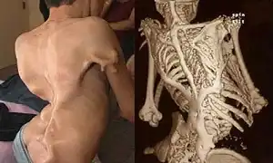 Người hoá đá té ra là thật và là 1 bệnh hiếm gặp