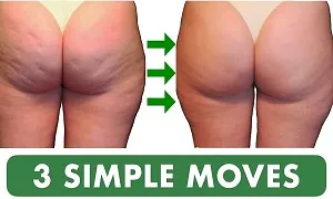 Phương pháp loại bỏ Cellulite tự nhiên và an toàn