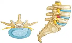 Người bị thoát vị đĩa đệm cần thiết phải tập kháng lực