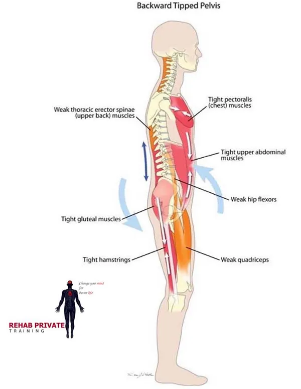 BACKWARD TIPPED PELVIS - Xương chậu nghiêng về phía sau BACKWARD TIPPED PELVIS - Xương chậu nghiêng về phía sau