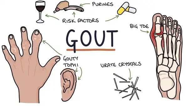 Minh hoạ đơn giản về bệnh Gout