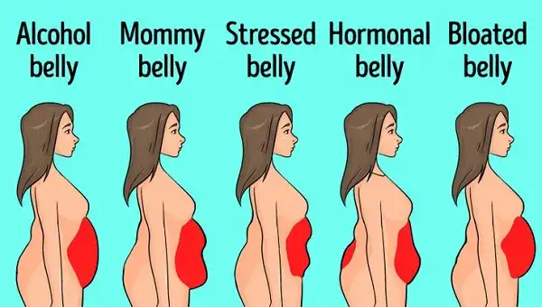 Các dạng tích mỡ bụng và giải pháp xử lý Các dạng tích mỡ bụng và giải pháp xử lý