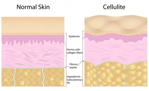 So sánh Cellulite và da bình thường So sánh Cellulite và da bình thường