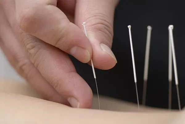 Châm cứu có thể làm giảm cơn đau do DOMS Châm cứu có thể làm giảm cơn đau do DOMS