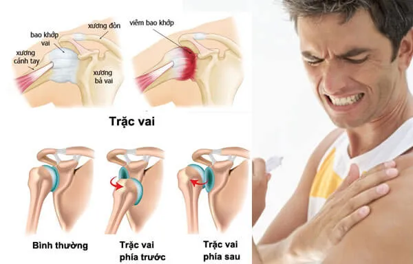 Chấn thương vai khi tập gym thể hình Chấn thương vai khi tập gym thể hình