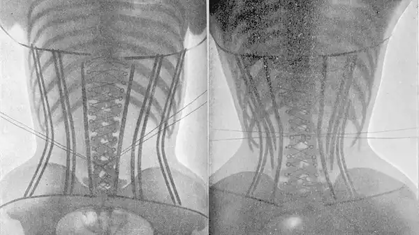 Đai lưng Corset làm biến dạng xương sườn, phổi, nội tạng Đai lưng Corset làm biến dạng xương sườn, phổi, nội tạng