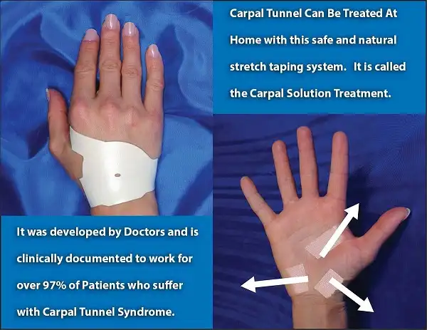 1 trong những cách điều trị hội chứng ống cổ tay là đeo nẹp 6 tháng