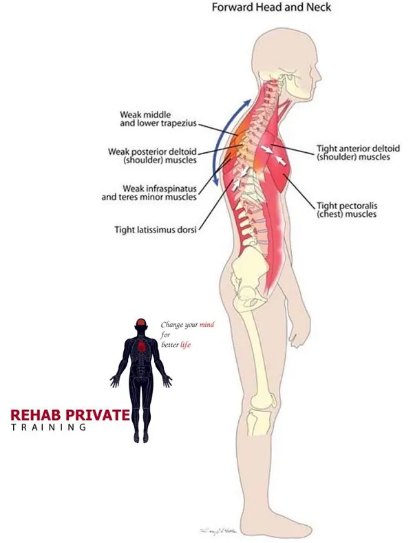 FORWARD HEAD NECK - Cổ đưa về trước FORWARD HEAD NECK - Cổ đưa về trước