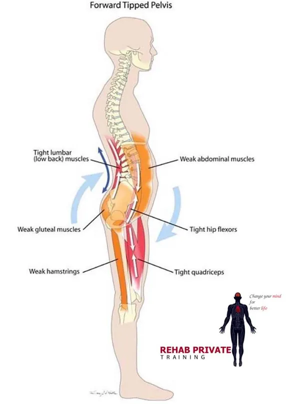 FORWARD TIPPED PELVIS – Xương chậu nghiêng về trước FORWARD TIPPED PELVIS – Xương chậu nghiêng về trước