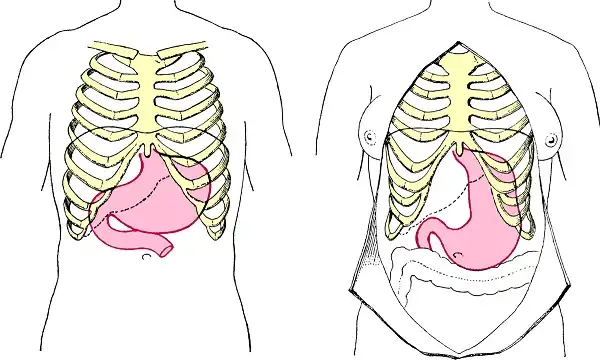Hệ tiêu hóa và xương sườn bị biến dạng vì đeo đai nịt bụng Hệ tiêu hóa và xương sườn bị biến dạng vì đeo đai nịt bụng