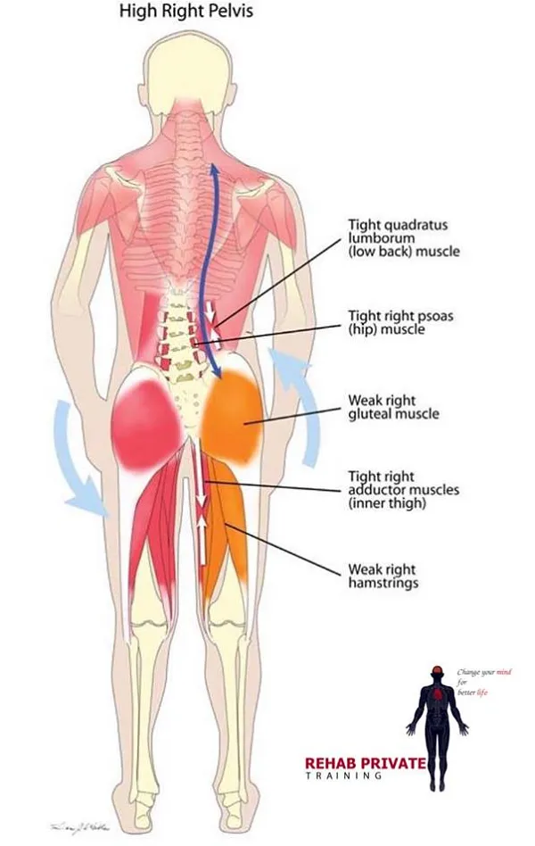 HIGH RIGHT PELVIS - Xương chậu bị lệch HIGH RIGHT PELVIS - Xương chậu bị lệch