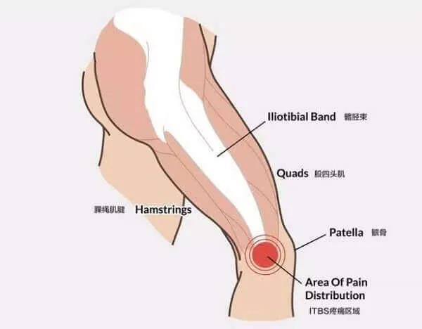 Hội chứng dải chậu chày - IT Band Hội chứng dải chậu chày - IT Band