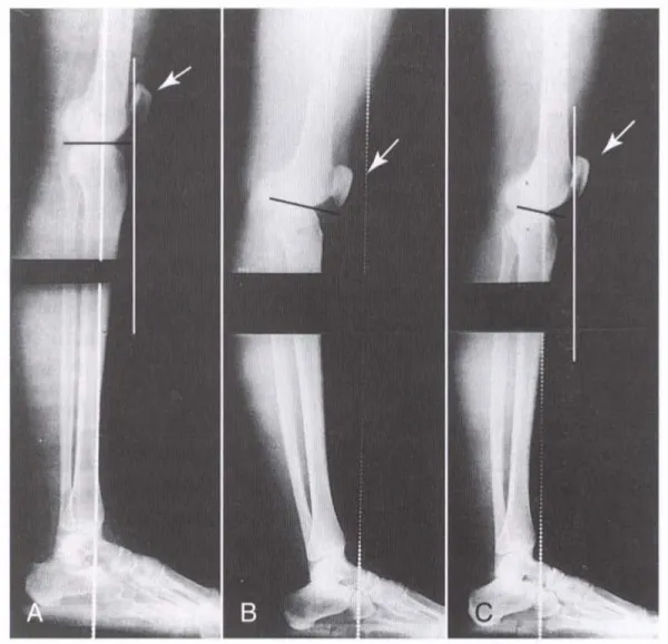 Khắc phục sai lệch tư thế đã tồn tại lâu rất khó thực hiện