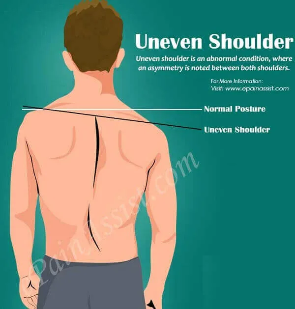 Khắc phục tình trạng vai bên cao bên thấp Khắc phục tình trạng vai bên cao bên thấp