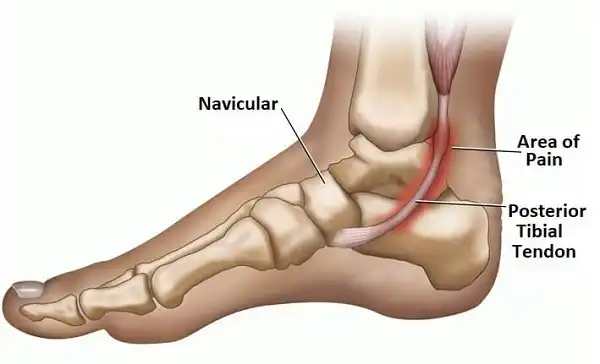 1 trong những nguyên nhân gây bàn chân bẹt 1 trong những nguyên nhân gây bàn chân bẹt