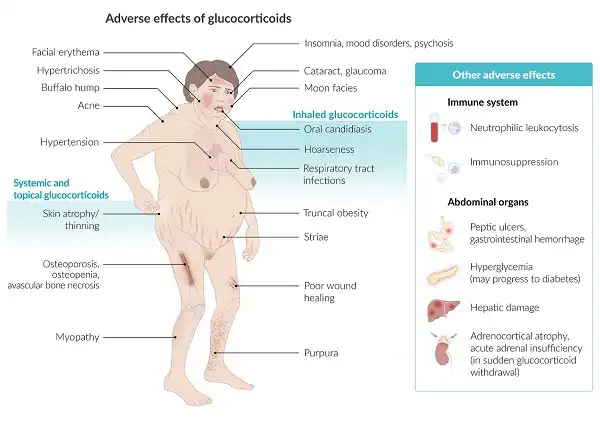 Những tác dụng không mong muốn của glucocorticoids