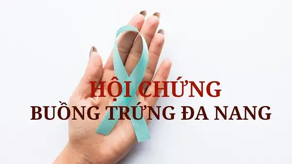 PCOS hay hội chứng buồng trứng đa nang