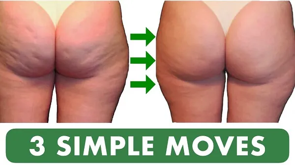 Phương pháp loại bỏ Cellulite tự nhiên và an toàn Phương pháp loại bỏ Cellulite tự nhiên và an toàn