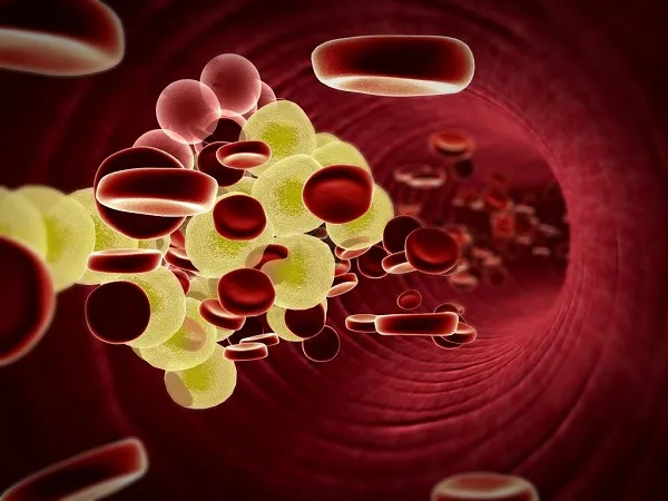 Rối loạn Lipid máu hay Dyslipidemia Rối loạn Lipid máu hay Dyslipidemia