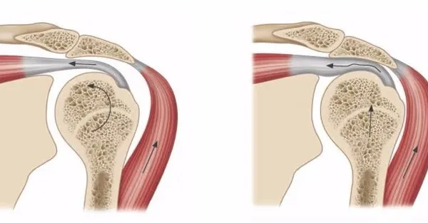 Tập tăng độ vững cho khớp để giữ chắc khớp