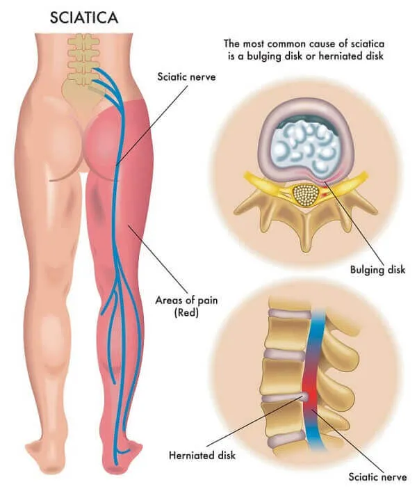 Mô phổng khi bị thoát vị đĩa đệm Mô phổng khi bị thoát vị đĩa đệm
