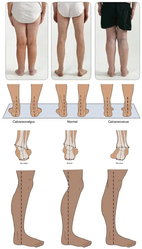 Tư thế đúng của đầu gối