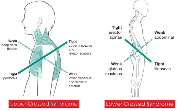 Upper Cross Syndrome và Lower Cross Syndrome